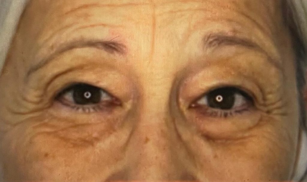 blepharoplastie avant